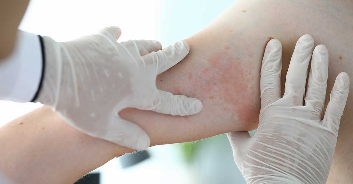 How Does Eczema Affect The Body?