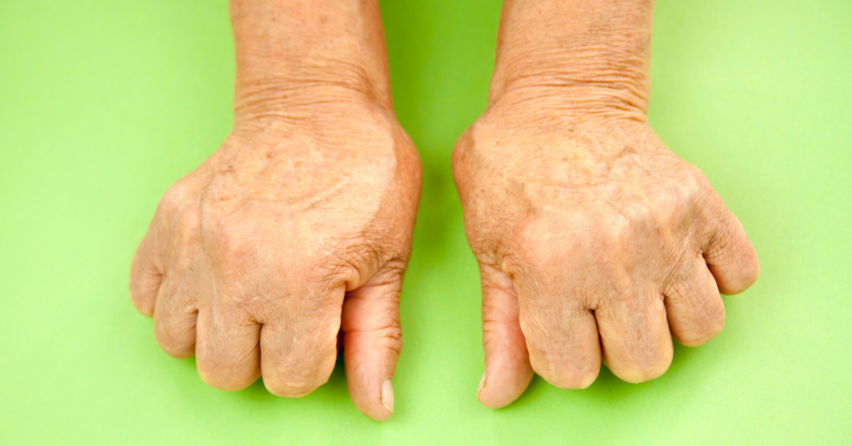 The rarity of contracting still’s disease