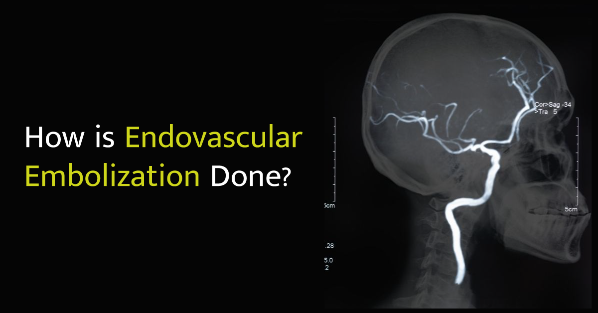 How is endovascular embolization done?