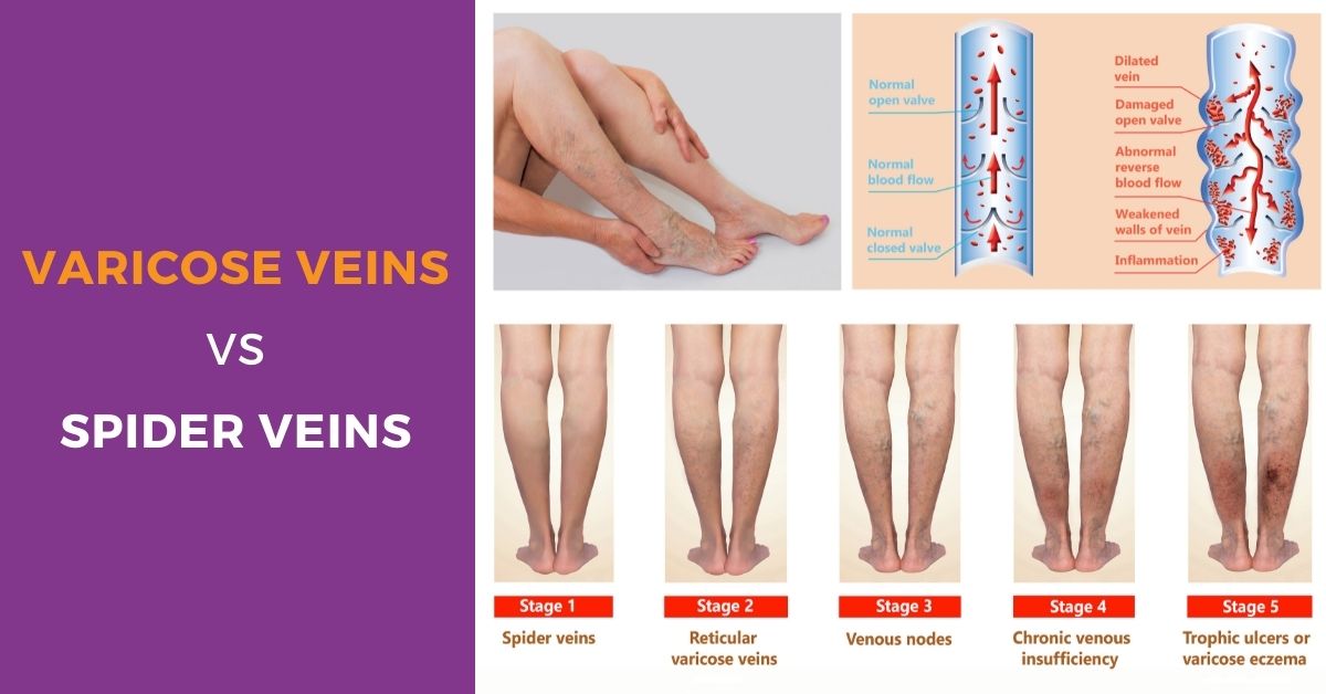 What is difference between spider veins and varicose veins?