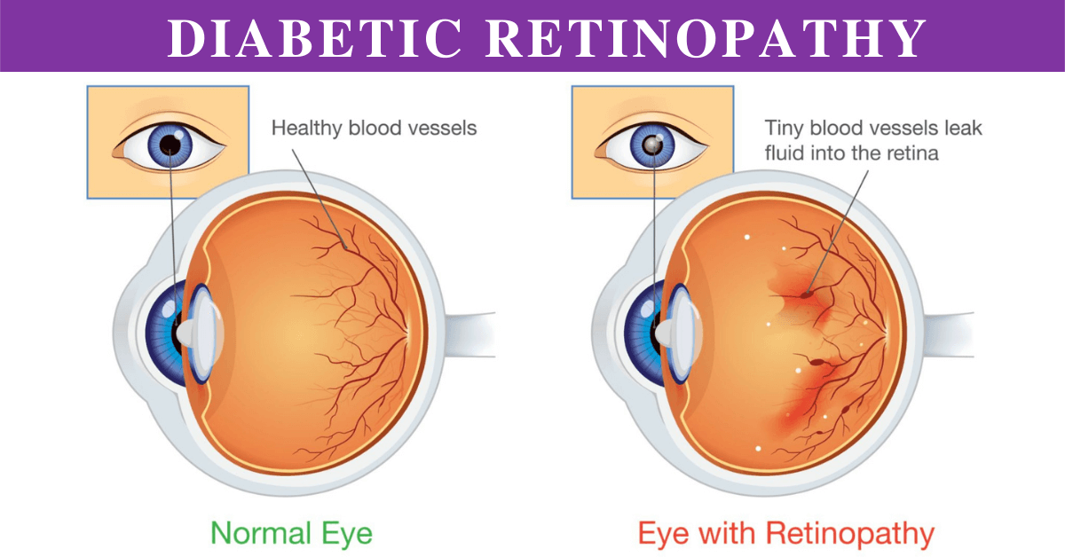 Diabetic Retinopathy Stages: How it’s treated?