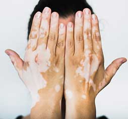 Best Vitiligo Treatment in Coimbatore - Sri Ramakrishna Hospital