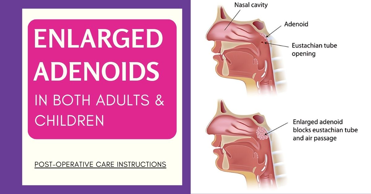 What should you expect during post-operative care after Adenoidectomy?