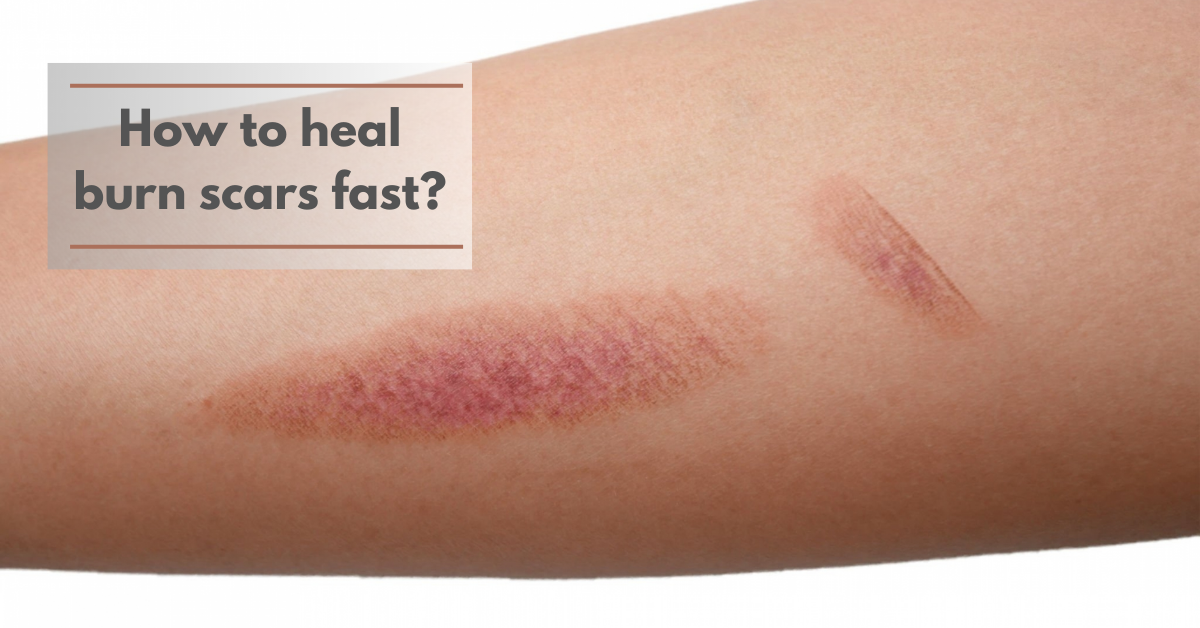 How to Heal Burn Scars Fast?