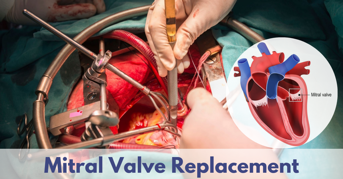 What Symptoms Indicate the Need for Mitral Valve Replacement?