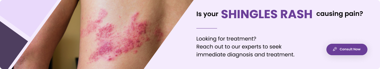 shingles - Sriramakrishanhospital