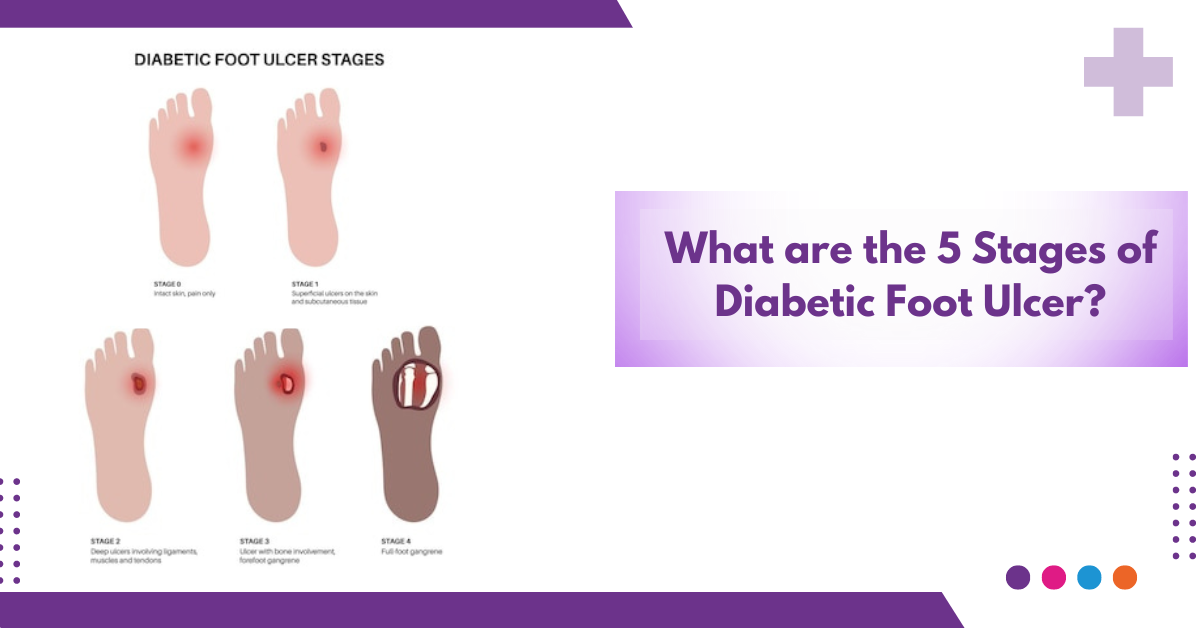 diabetic foot ulcer-Sriramakrishnahospital